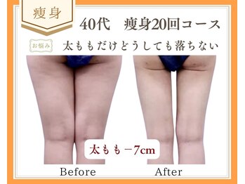 リュミエール(Lumiere)/【症例】脂肪分解