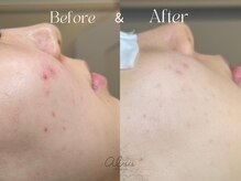 アイシス(AIsis)/【LDM/20代】定着ニキビ/美白