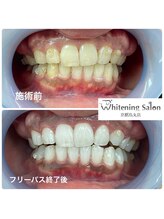 ホワイトニングサロン 京都烏丸店/ホワイトニング施術例