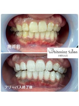 ホワイトニングサロン 京都烏丸店/ホワイトニング施術例