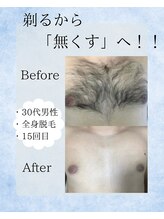 ポーベル(Peau belle)/胸毛脱毛　Before →After 