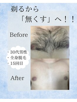 ポーベル(Peau belle)/胸毛脱毛　Before →After 