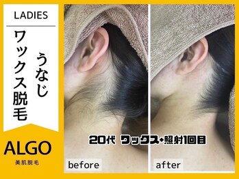 アルゴ 豊中岡町駅前店(ALGO)/【うなじ脱毛 WAX大人気パーツ】