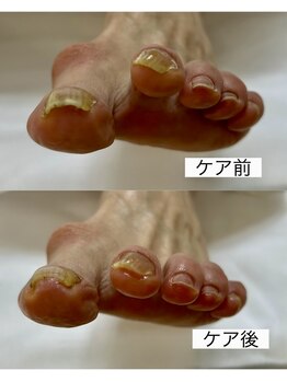 おん/爪ケア症例2025.4.1