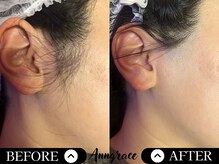 アングレイス(Anngrace)/お顔脱毛もみあげ。Before/After
