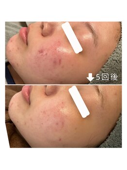 エヌプラス(N+)/20代女性＊ピーリング5回後(2)