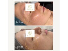 ティンクル(Twinkle)/年齢肌・目尻小じわ