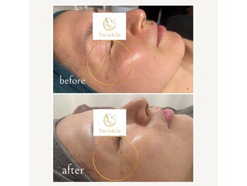 ティンクル(Twinkle)/年齢肌・目尻小じわ