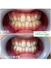 ホワイトニングサロン 名古屋駅店/【ホワイトニング施術例】