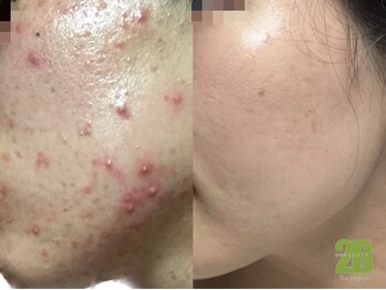 ナンバー19(N°19)/ハーブピーリング