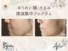 【ほうれい線・たるみケア】集中プログラム　顔全体施術　　体験クーポン