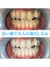 【2回目以降＊都度払い】食事やデート前に!ホワイトニング16分×照射2回¥3650
