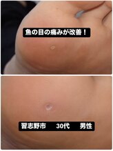 巻き爪じゅん 船橋店/魚の目による痛みが改善