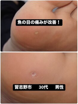 巻き爪じゅん 船橋店/魚の目による痛みが改善