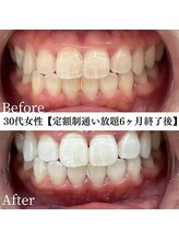 ホワイト 福岡天神店(WHITE)/ホワイトニングビフォーアフター