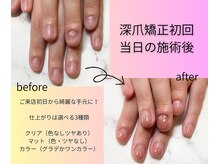 深爪矯正がしたい方必見!!10年以上経験のベテランネイリスト