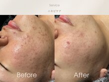 フェイシャルサロン ベルダ(BELDA)/【ニキビケアBefore After 】