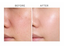 ザ ギフト 栄(The Gift)/トロイアルケで毛穴レス！