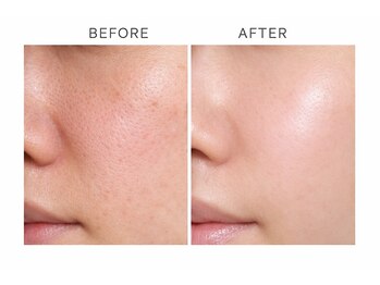 ザ ギフト 栄(The Gift)/トロイアルケで毛穴レス！