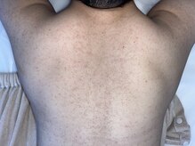 ビューティリュクス(beauty luxe)/before/リベルハーブピーリング