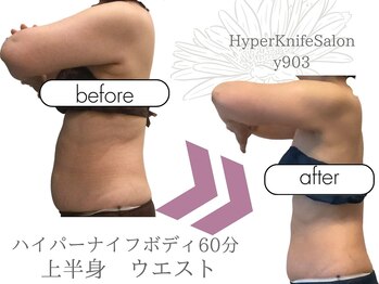 ワイキューマルサン(y903)/ハイパーナイフボディ60分上半身