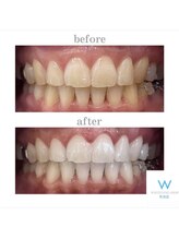 ホワイトニングショップ 町田店/【ビフォーアフター】10回
