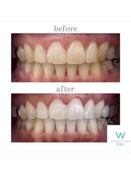 ホワイトニングショップ 町田店/【ビフォーアフター】10回