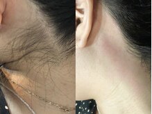 ウー(Wu)/wax脱毛(うなじ)