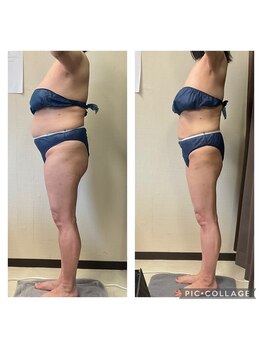 ビボディラボ 海老名店(美Body Labo)/50代(5ヶ月)