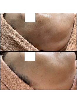 リッツ 草加店(Ritz)/【Before/After】シミ改善