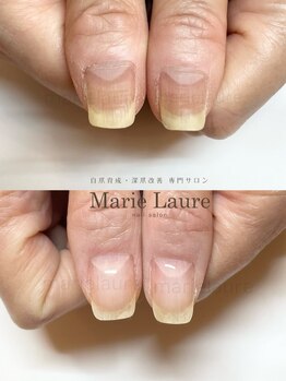 マリーロール 梅田店(Marie Laure)/深爪矯正/自爪育成/自爪風