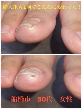 巻き爪じゅん 千葉駅前店/陥入爪も1回でこんなに変わった