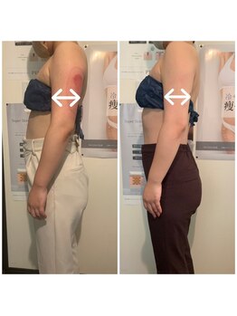 ネイルアンドリラクゼーション アン(nail&relaxation An)/脂肪冷却2カップ