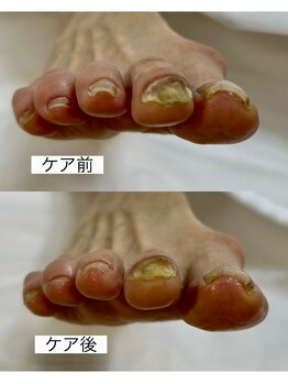 おん/爪ケア症例2025.4.1