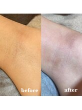 エクラーレ(ECLARE)/脇のビフォーアフター