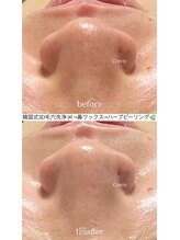 クレヴィー(Creviy)/韓国式3D毛穴洗浄＋ハーブ＋脱毛