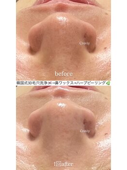 クレヴィー(Creviy)/韓国式3D毛穴洗浄+ハーブ+脱毛