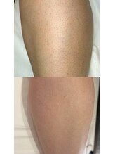 スキンラウンジ(SKIN LOUNGE)/圧倒的効果｜LED脱毛