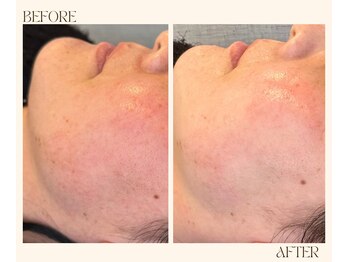 レヴ 都城店(rev)/乾燥からくる赤みに!