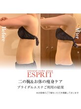 エスプリ 銀座店/ブライダル痩身で二の腕スッキリ