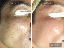 アムールサロン(Amour salon)/光フェイシャルでシミケア/新宿