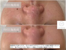 ハーブピーリング専門LV江坂　-ハーブピーリング/毛穴/毛穴ニキビシミケア-/ダイヤモンドハーブピーリング