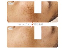 シミケア専門店O.B.M 博多阪急店/シミケア