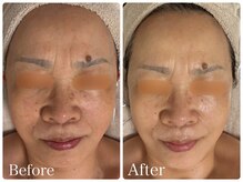 ロイヤル(ROYAL)/シミ/くすみ改善症例