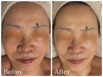 ロイヤル(ROYAL)/シミ/くすみ改善症例