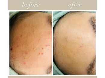 サロン デ モンターニユ(SALON DES montagnes)の写真/本気で変わる！繰り返すニキビに自信あり◎何をやってもうまくいかなかったあなたへ美肌への近道をご提案！