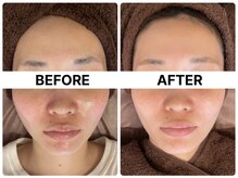 ハーブピーリング 恵比寿/毛穴引締め/トーンアップハーブ