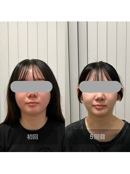 ナギ鍼灸院(nagi鍼灸院)/美容鍼コース　ビフォーアフター