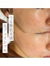 シミ、しわ、くすみケアに◎【光フェイシャル】６０分