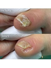 巻き爪補正店 越谷店/副爪(小指の横にできる硬い角質)